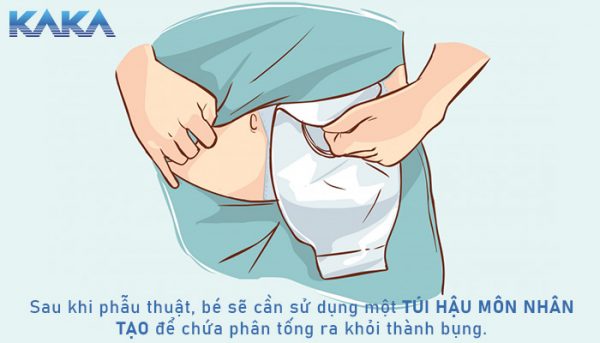 Tui-hau-mon-nhan-tao-cho-tre-nho